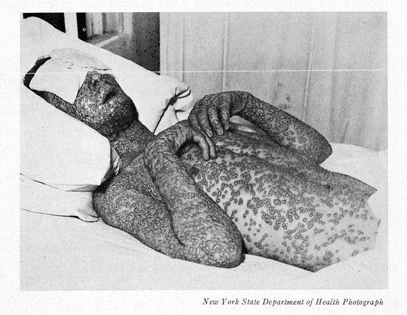 Smallpox victim Smallpox victim